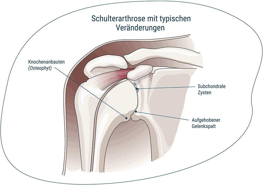 OPL – Illustration Schulterarthrose